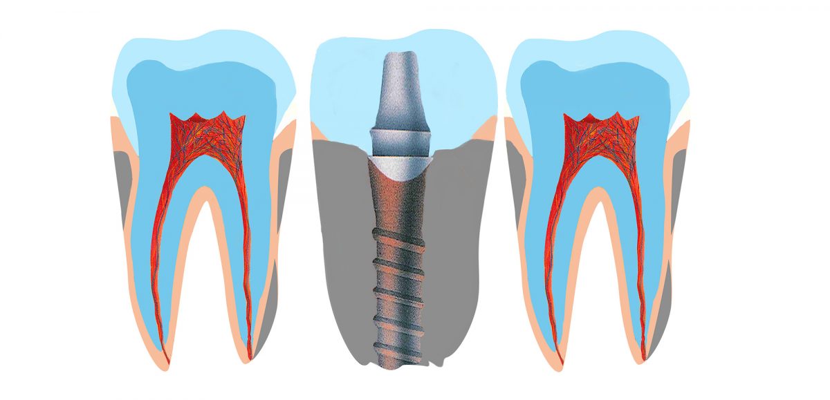 implants-dentaires